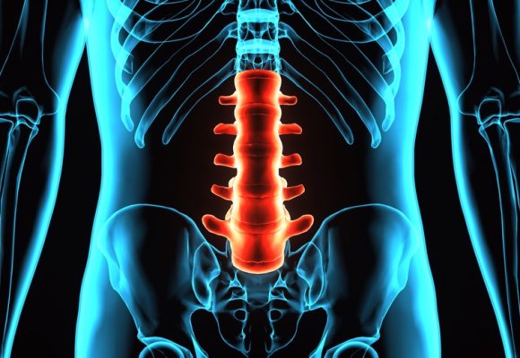 Illustration d'une arthrodèse antérieure